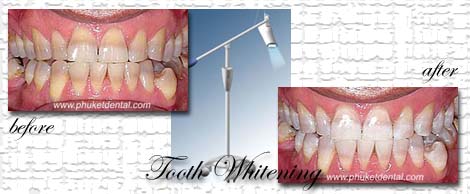 Tooth Whitening:Coldlight,non-LASER,LED,Natural Plus at Phuket Dental Clinic,Thailand